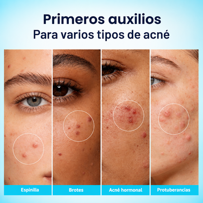 Loción Secante para Granos con Ácido Salicílico 1.8% – Tratamiento Puntual Antiacné