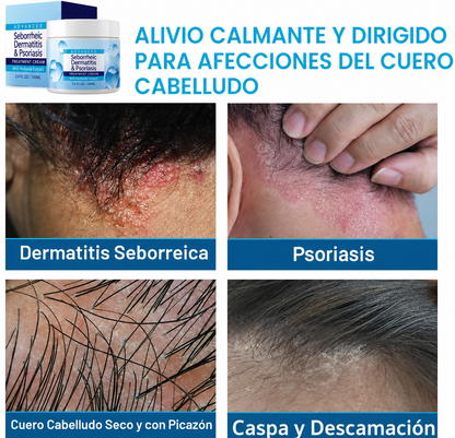 Crema para Dermatitis Seborreica, Caspa y Picazón del Cuero Cabelludo | Alivio e Hidratación