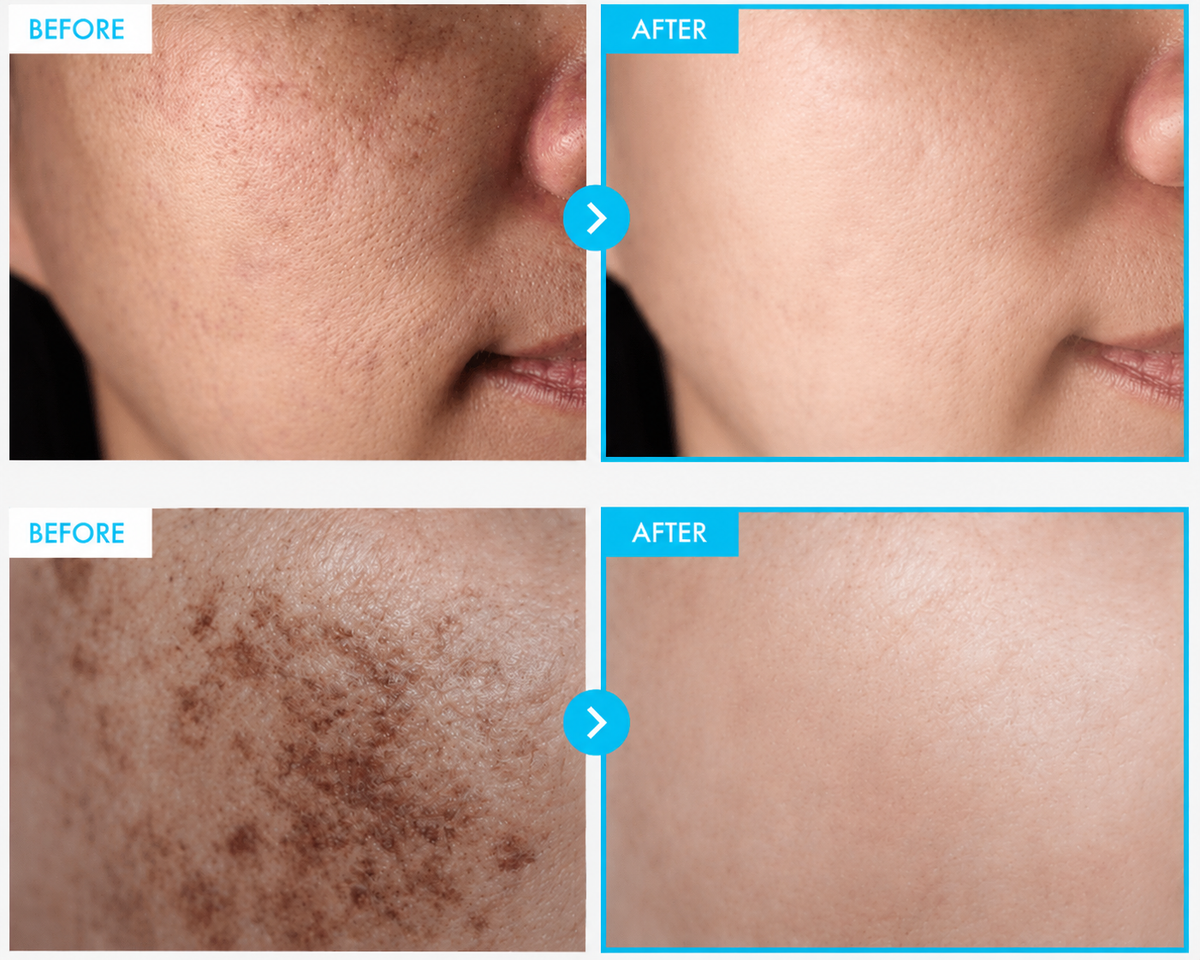 Crema del Cuidado de la Piel Coreana Para Manchas Oscuras, Pecas, Imperfecciones y Pigmentación