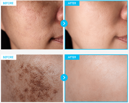 Crema del Cuidado de la Piel Coreana Para Manchas Oscuras, Pecas, Imperfecciones y Pigmentación